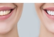 Side-by-side comparison of a person smiling, showing yellowish teeth on the left and noticeably whiter teeth on the right.