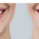 Side-by-side comparison of a person smiling, showing yellowish teeth on the left and noticeably whiter teeth on the right.