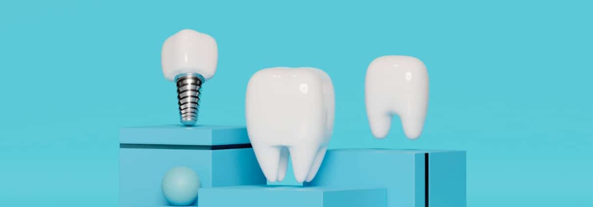 3D render of two white teeth and a dental implant model displayed on blue geometric platforms against a blue background.