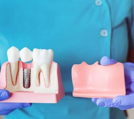 Person in blue clothing and purple gloves holding dental models: one shows a dental implant and teeth, the other shows a jaw with missing teeth.