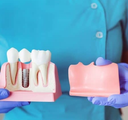 Person in blue clothing and purple gloves holding dental models: one shows a dental implant and teeth, the other shows a jaw with missing teeth.